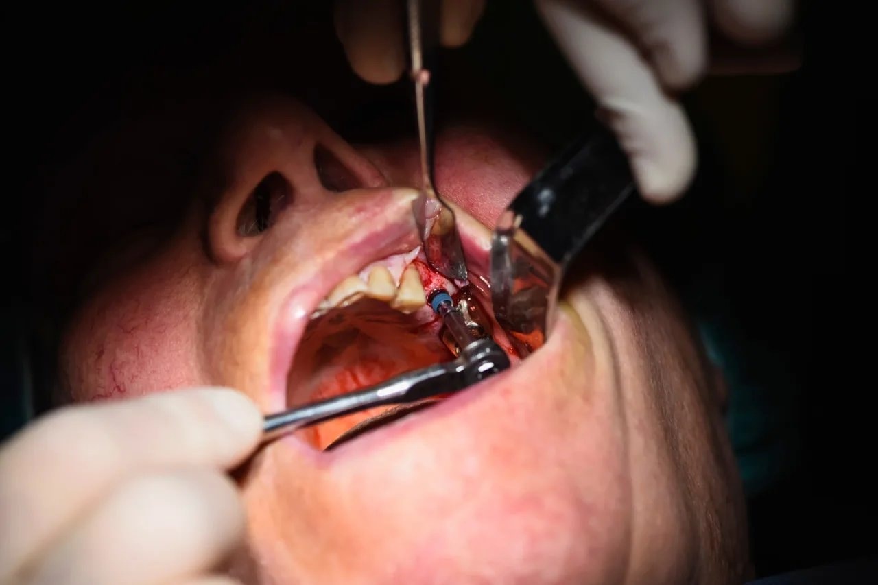 GN Dental Yuba City | Extracción de Muelas del Juicio