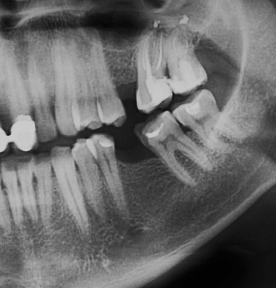 GN Dental Yuba City | Digital X-ray used to detect cavities