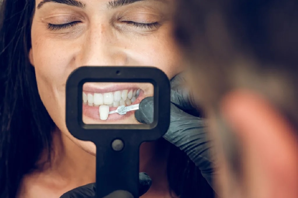 GN Dental Yuba City | Carillas de Porcelana