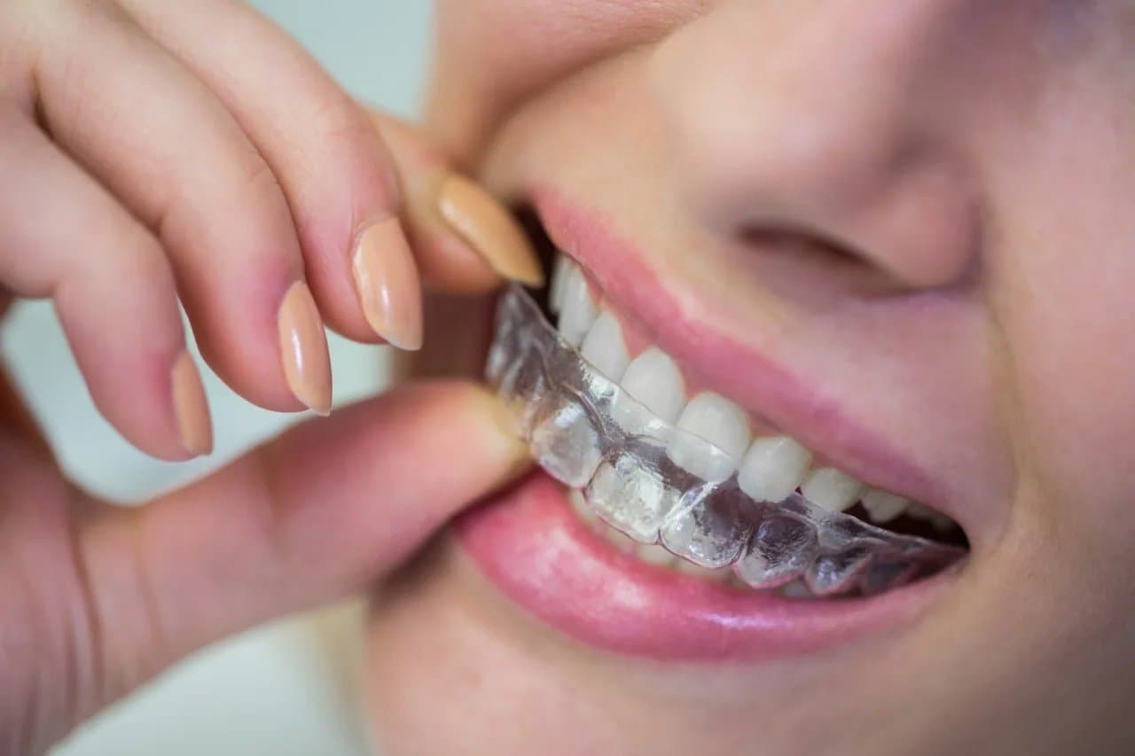 GN Dental Yuba City | Straightening crooked teeth