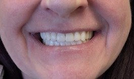 GN Dental Yuba City | Fotos de Antes y Después