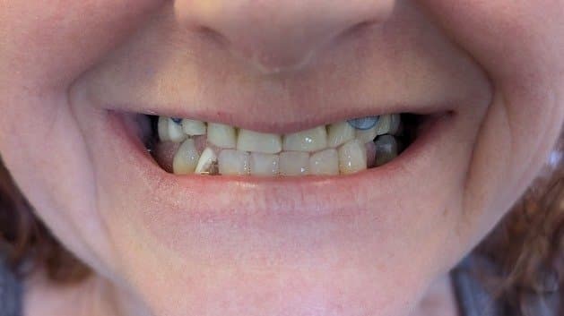 GN Dental Yuba City | Before & After Photos