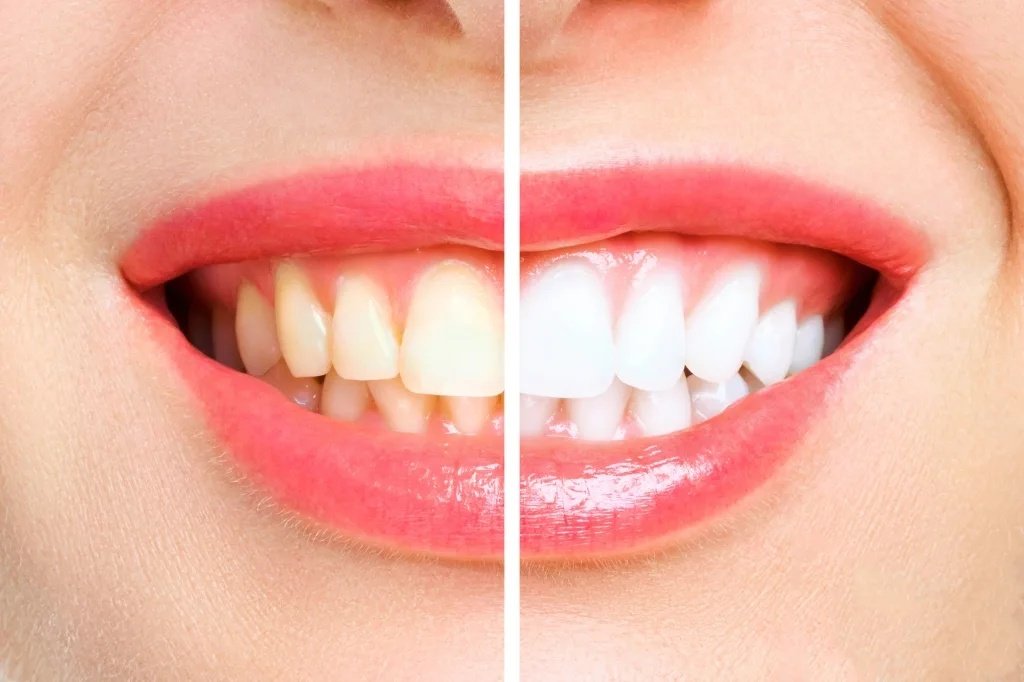 GN Dental Yuba City|Teeth Whitening / Cleaning
