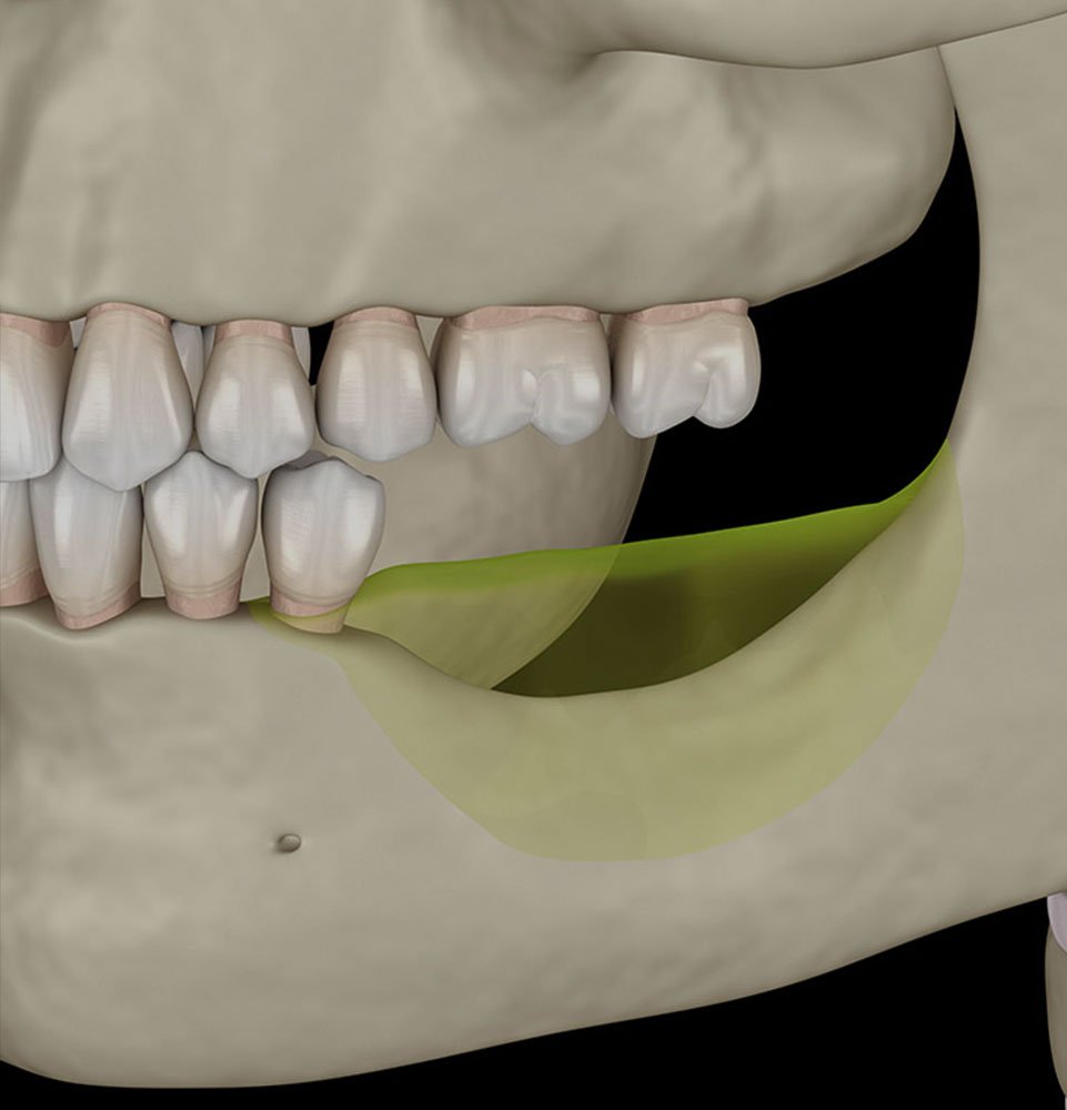 GN Dental Yuba City | Implant