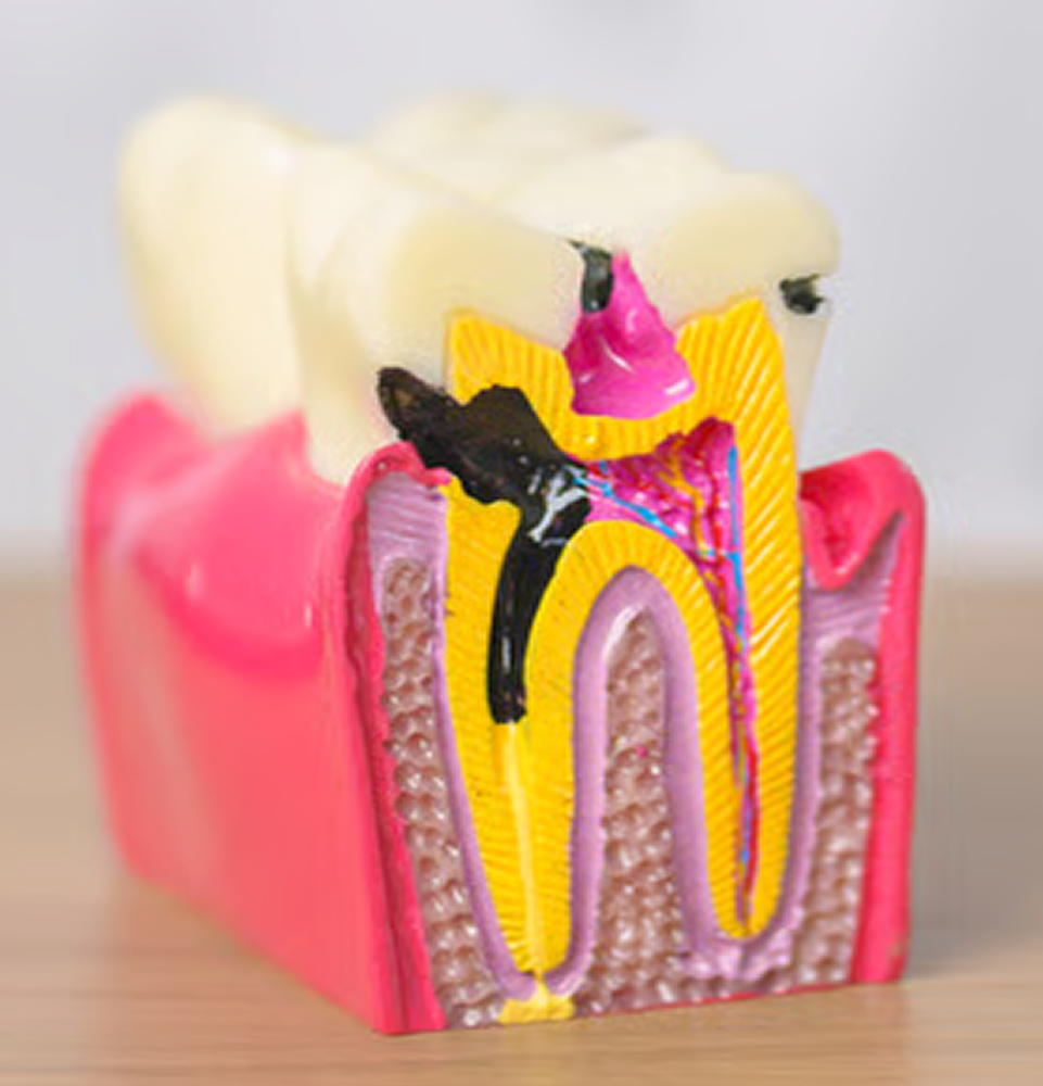 GN Dental Yuba City | Implant